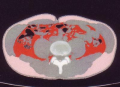 メタボ：内臓脂肪と腹囲