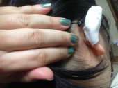 耳手術 画像1