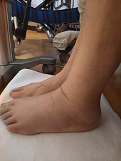 松葉杖で廊下2周 画像2