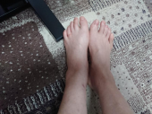 火傷 画像1